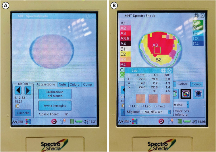 Effects of different curing methods on the color stability of composite resins.