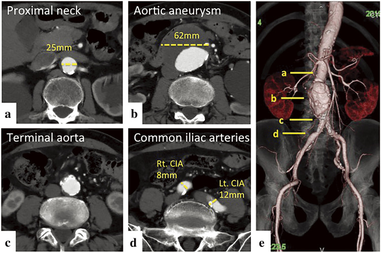 Spinal Cord Infarction after Endovascular Aortic Repair for Infrarenal Abdominal Aortic Aneurysm.