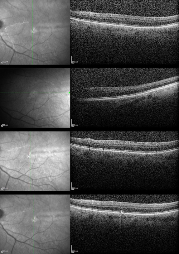 Foveal Hypoplasia in Presumed Xeroderma Pigmentosum: A Case Report.