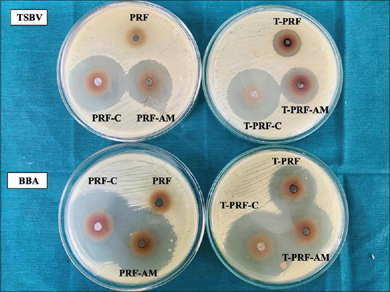 Evaluation of antimicrobial activity of platelet-rich fibrin and titanium platelet-rich fibrin with and without incorporation of antibiotics on <i>Porphyromonas gingivalis</i> and <i>Aggregatibacter actinomycetemcomitans</i>: An <i>in vitro</i> study.