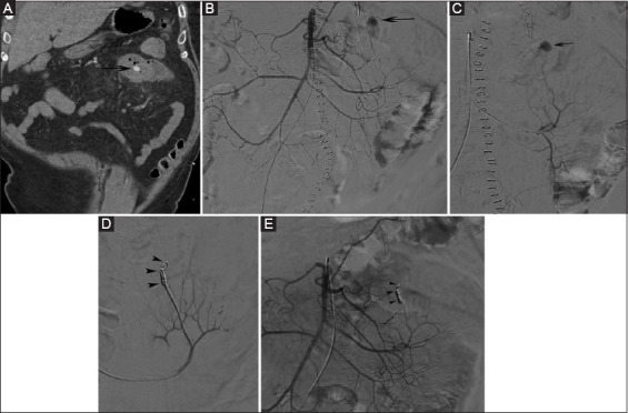 Transcatheter arterial embolization for small-bowel bleeding: technical and clinical outcomes and risk factors for early recurrent bleeding.