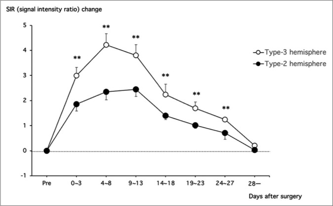 Reversible sulcal fluid-attenuated inversion recovery hyperintensity after combined bypass surgery for moyamoya disease - A "crevasse" sign.