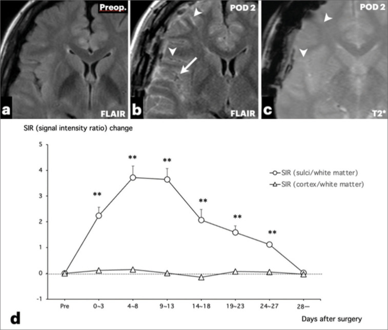Reversible sulcal fluid-attenuated inversion recovery hyperintensity after combined bypass surgery for moyamoya disease - A "crevasse" sign.