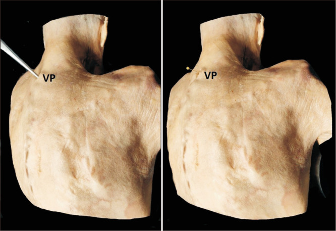 Variability in the projection level of the vertebra prominens: a cadaveric study.