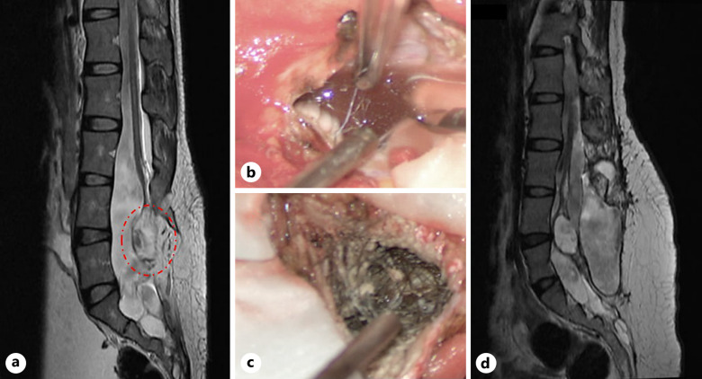 Spinal Teratoma with Recurrent Epileptic Episodes in Adults: A Case Report.