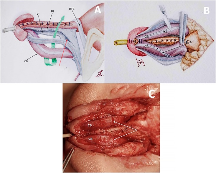 Modified penile reconstruction in classic bladder exstrophy: Can complete corporal covering of the urethral closure be achieved using incomplete disassembly technique?