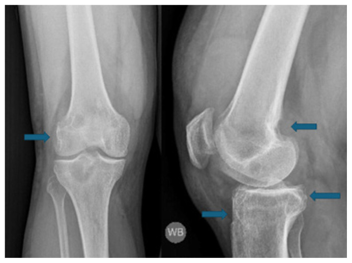Pigmented Villonodular Synovitis: A Critical Review.