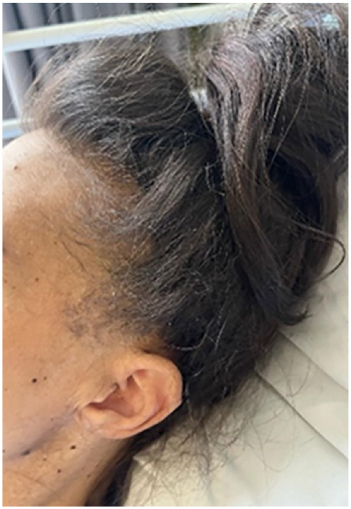 Myxedema ascites? A rare presentation of ascites in severe hypothyroidism: A case report and review.