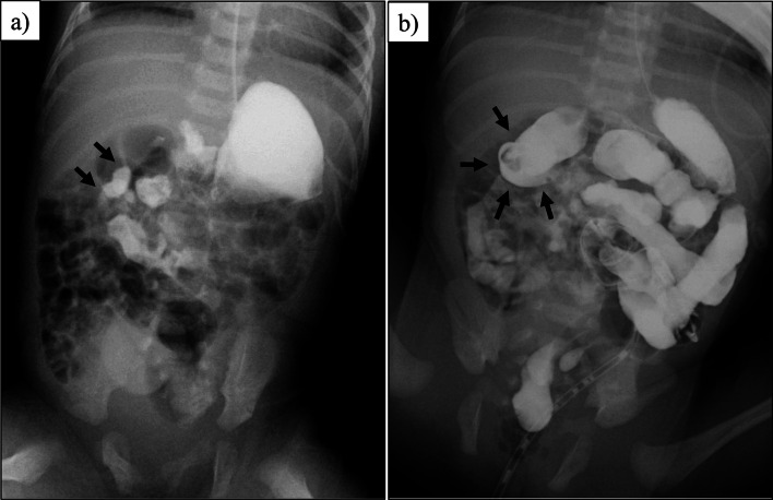 A case of isolated malrotation without midgut volvulus diagnosed prenatally and treated by laparoscopic surgery.