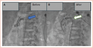 Endovascular Intervention for Acute Superior Mesenteric Artery Occlusion Following COVID-19 Pneumonia: Two Case Reports.