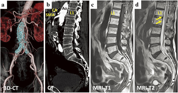 Spinal Cord Infarction after Endovascular Aortic Repair for Infrarenal Abdominal Aortic Aneurysm.