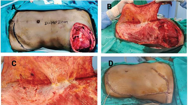 Medially Based "Abdominal Rotation Advancement Flap": A Promising Technique for Mastectomy Defect Reconstruction in "High-Risk Patients" Awaiting Adjuvant Radiotherapy.