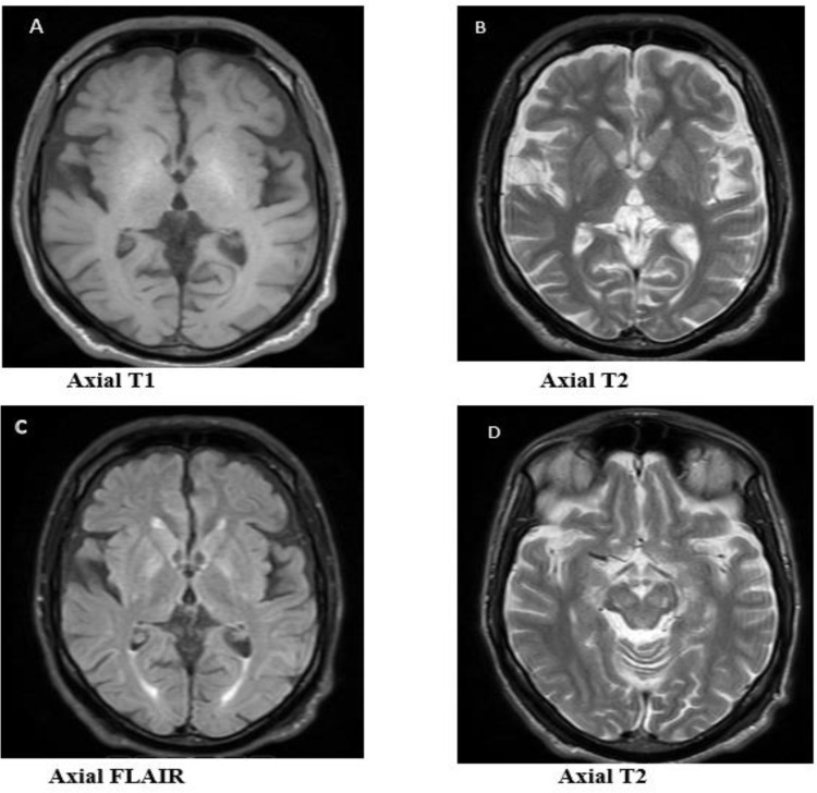 Usefulness of the Leipzig Score in the Diagnosis of Wilson's Disease - A Diagnostically Challenging Case Report.