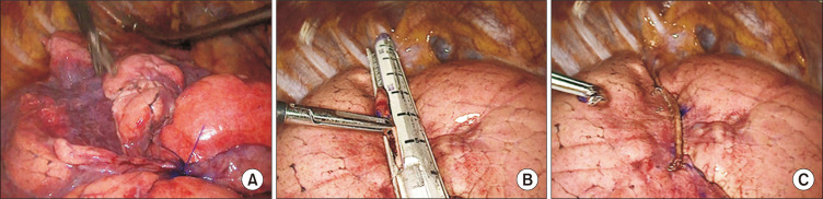 Interfissural Fixation of the Right Middle Lobe after Video-Assisted Thoracic Surgery Right Upper Lobectomy: Bronchial Anatomical Changes and Efficacy in Preventing Torsion.