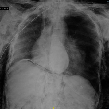 Endotracheal Oxygen Insufflation Associated with Life-Threatening Barotrauma during Apnea Testing.