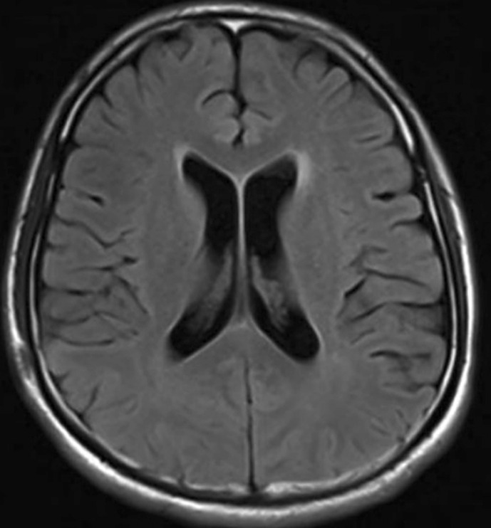 Spinal Teratoma with Recurrent Epileptic Episodes in Adults: A Case Report.