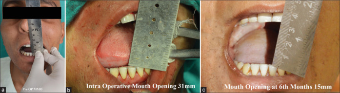 Assessment of the role of coronoid in restrictive jaw disorders and physiologic mandibular movements.