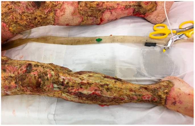 Diagnosis and Treatment of Infections in the Burn Patient.