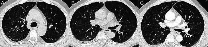 Fluctuating obliterative bronchiolitis in RET-mutant medullary thyroid cancer patient treated with selpercatinib.