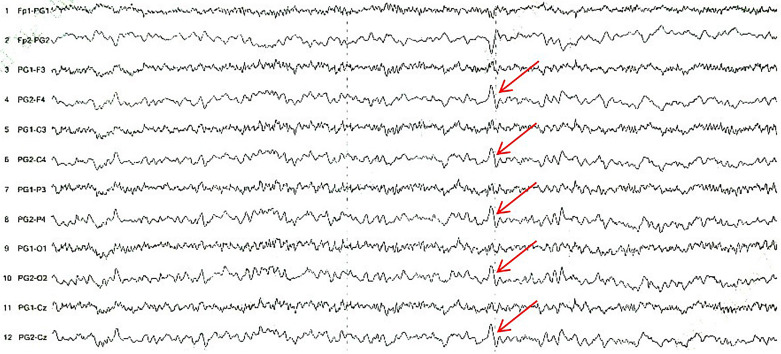 Spinal Teratoma with Recurrent Epileptic Episodes in Adults: A Case Report.