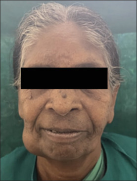 Mandibular lateral ectopia: A rare case presentation.