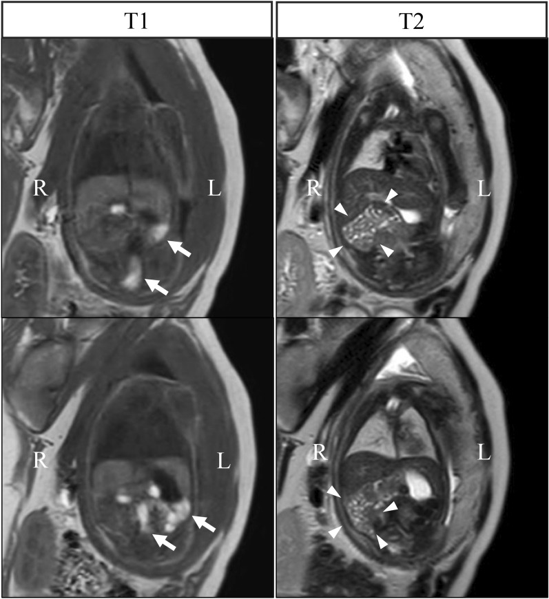 A case of isolated malrotation without midgut volvulus diagnosed prenatally and treated by laparoscopic surgery.
