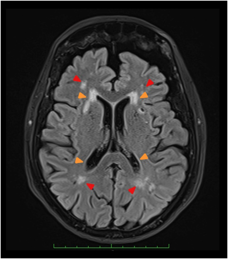 Vascular cognitive impairment and dementia: a narrative review.