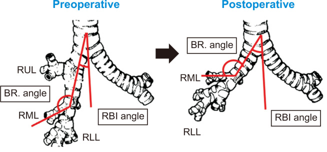 Interfissural Fixation of the Right Middle Lobe after Video-Assisted Thoracic Surgery Right Upper Lobectomy: Bronchial Anatomical Changes and Efficacy in Preventing Torsion.