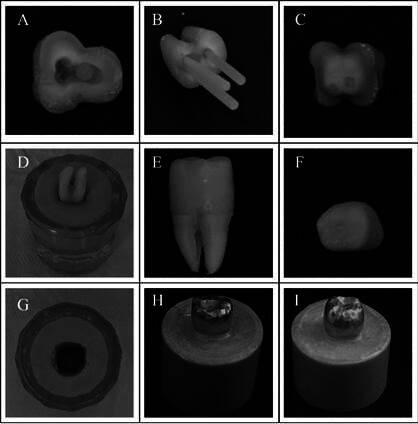 Exploring fiberglass post numbers for enhanced fatigue resistance in molars without coronary remnants.