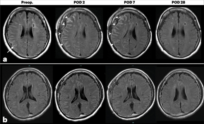 Reversible sulcal fluid-attenuated inversion recovery hyperintensity after combined bypass surgery for moyamoya disease - A "crevasse" sign.