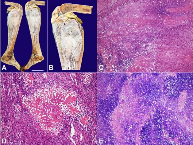 Chondroblastic Osteosarcoma of proximal tibia.
