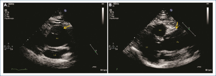 Asymptomatic stanford A aortic dissection in a patient with chronic kidney disease.