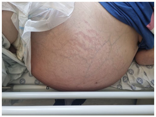 Myxedema ascites? A rare presentation of ascites in severe hypothyroidism: A case report and review.