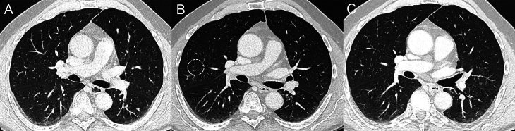 Fluctuating obliterative bronchiolitis in RET-mutant medullary thyroid cancer patient treated with selpercatinib.