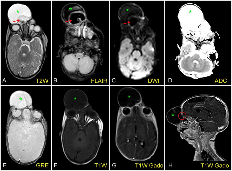 Unusual Case of Fetal Meningocele Mimicking Dacryocystocele.