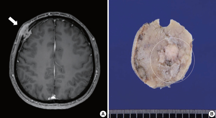 Rhabdomyosarcoma of the skull with EWSR1 fusion and ALK and cytokeratin expression: a case report.