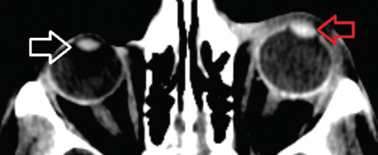 "Don't miss the globe" - Study of diagnostic accuracy of computed tomography in detecting open globe injury.