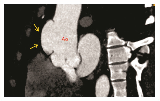 Asymptomatic stanford A aortic dissection in a patient with chronic kidney disease.