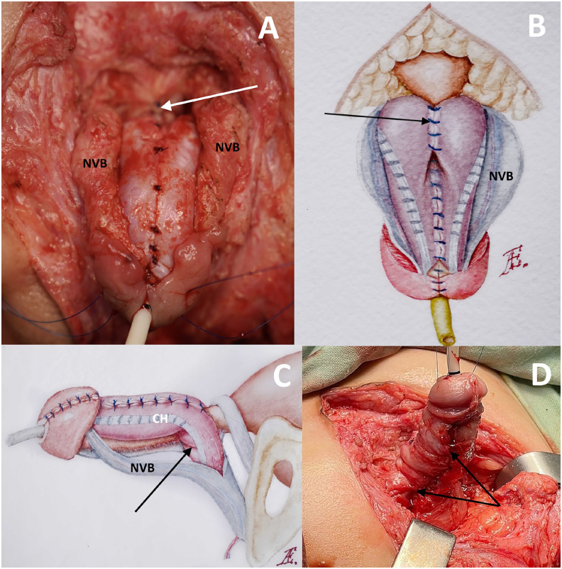 Modified penile reconstruction in classic bladder exstrophy: Can complete corporal covering of the urethral closure be achieved using incomplete disassembly technique?