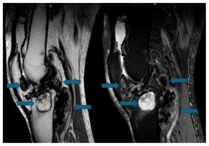 Pigmented Villonodular Synovitis: A Critical Review.