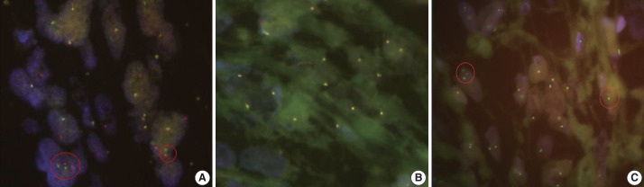 Rhabdomyosarcoma of the skull with EWSR1 fusion and ALK and cytokeratin expression: a case report.