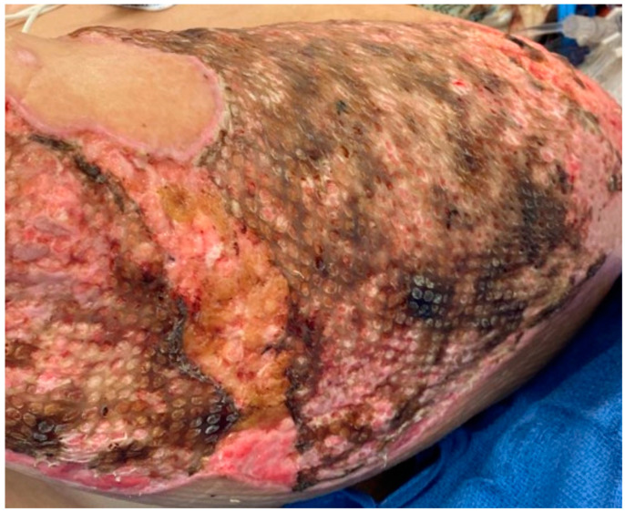 Diagnosis and Treatment of Infections in the Burn Patient.