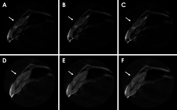 Combination of metal artifact reduction and sharpening filter application for horizontal root fracture diagnosis in teeth adjacent to a zirconia implant.