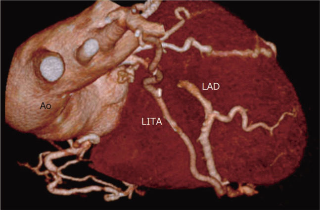 Coronary-Pulmonary Artery Fistula Provides Collateral Flow to an Occluded Left Anterior Descending Artery.