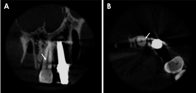 Combination of metal artifact reduction and sharpening filter application for horizontal root fracture diagnosis in teeth adjacent to a zirconia implant.