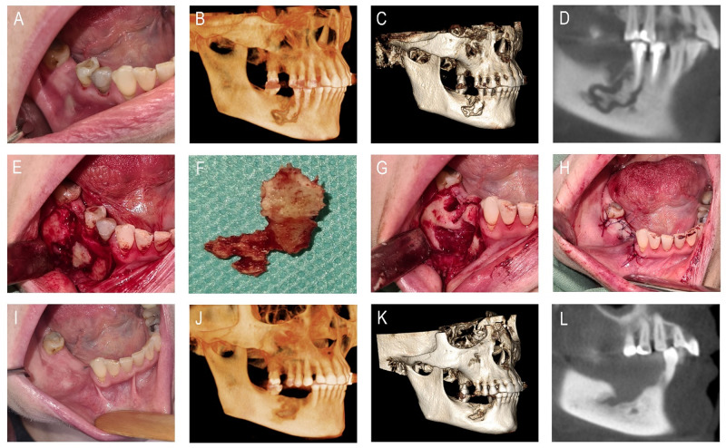 Secukinumab Causing Medication-Related Osteonecrosis of the Jaw, in a Patient Diagnosed with Psoriasis and Rheumatoid Arthritis.
