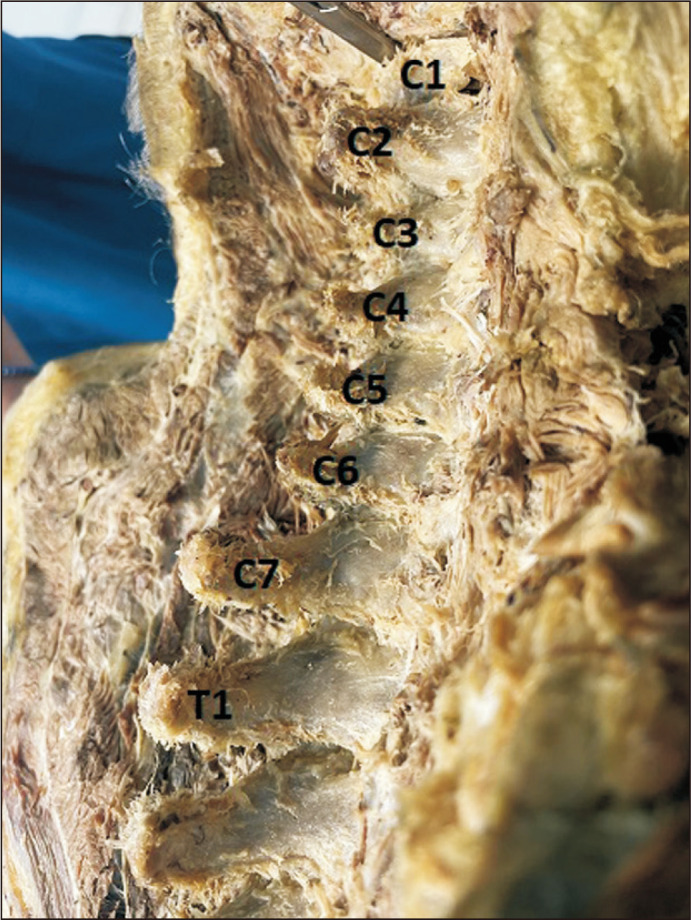 Variability in the projection level of the vertebra prominens: a cadaveric study.