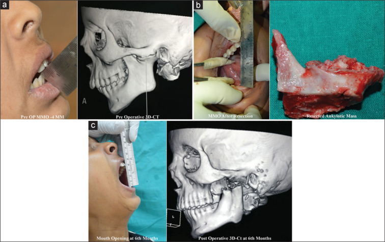 Assessment of the role of coronoid in restrictive jaw disorders and physiologic mandibular movements.