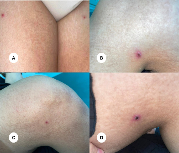 Chlorzoxazone-Induced Fixed Drug Eruption: A Clinical Case Report.