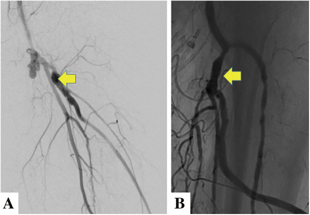 Infrapopliteal Surgical and Endovascular Intervention.
